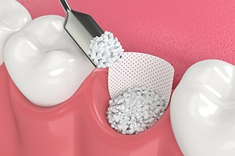 Illustration of a bone graft