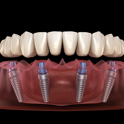 Illustration of All-on-4 implants in San Marcos