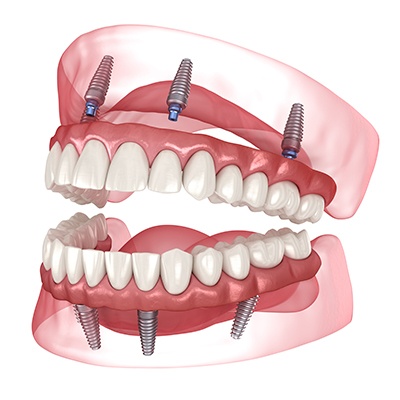 Illustration of All-on-4 for upper and lower jaw