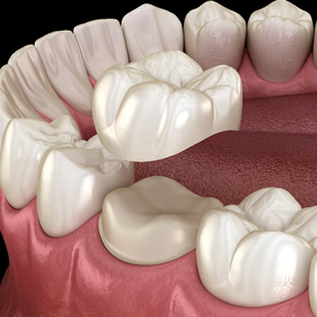a 3 D illustration of a dental crown being placed over a tooth