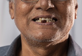 Man has missing teeth