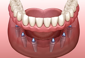 3D render of implant dentures