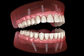 Illustration of all-on-4 dentures