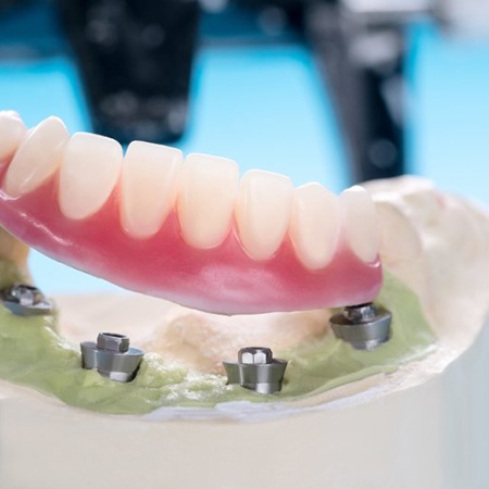A wax model of an implant denture
