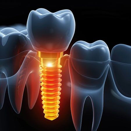 a 3D illustration of a problematic dental implant